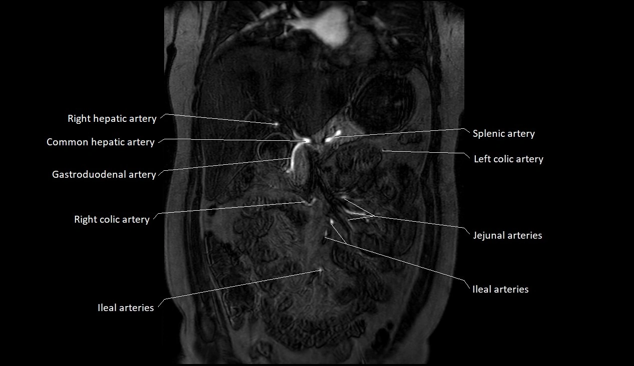MRA Abdomen coronal anatomy image 3.webp